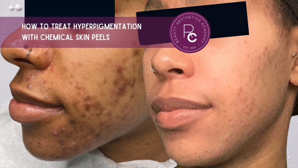 Determining How Many Chemical Peels For Hyperpigmentation