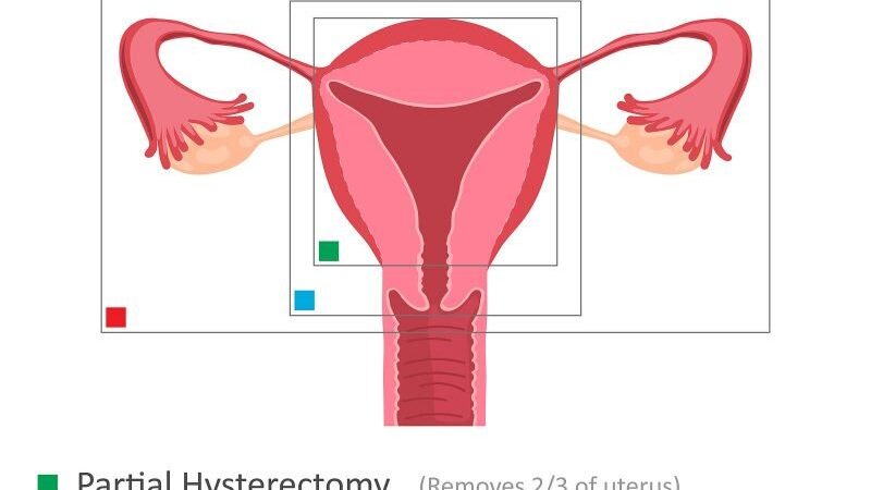Cost Of Hysterectomy Without Insurance: Explained