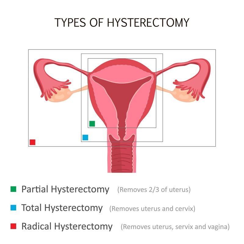Cost Of Hysterectomy Without Insurance: Explained