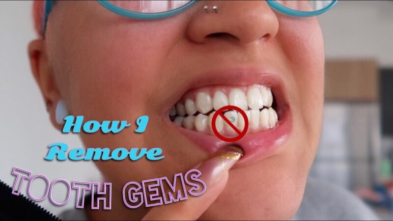 Efficient Ways To Remove Tooth Gems: How To Get Tooth Gems Off